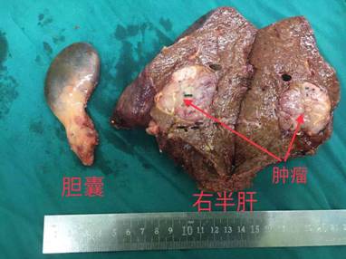 我院首例腹腔镜下前入路解剖性右半肝切除术顺利实施